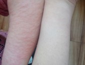 Ասեղային էպիլյացիա